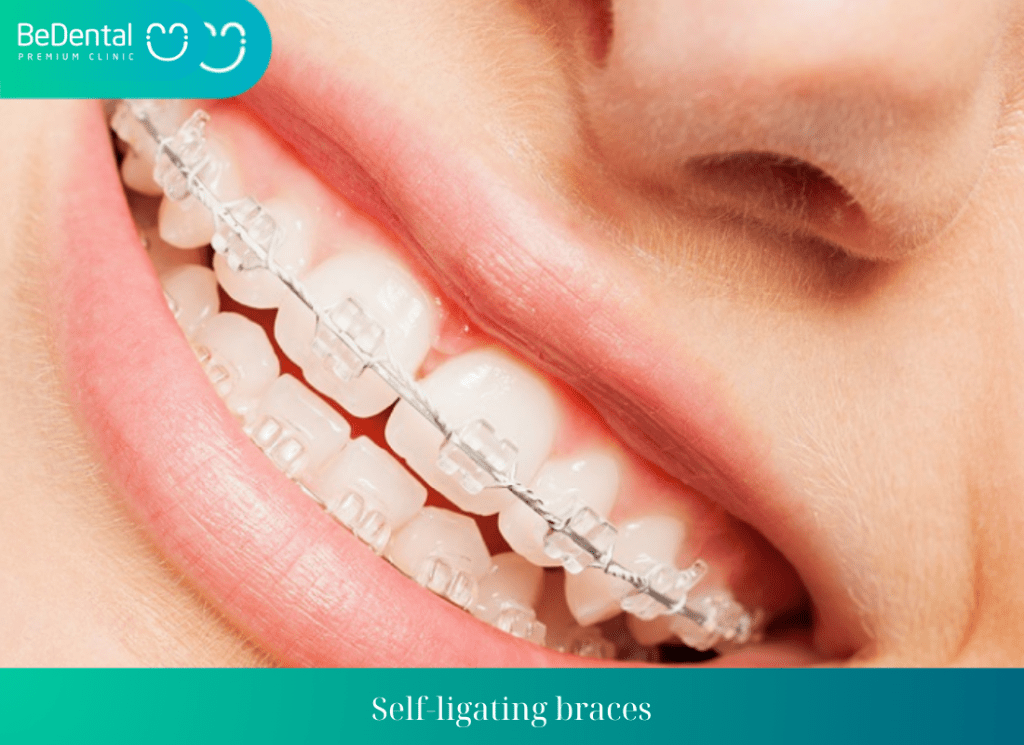 Self ligating braces