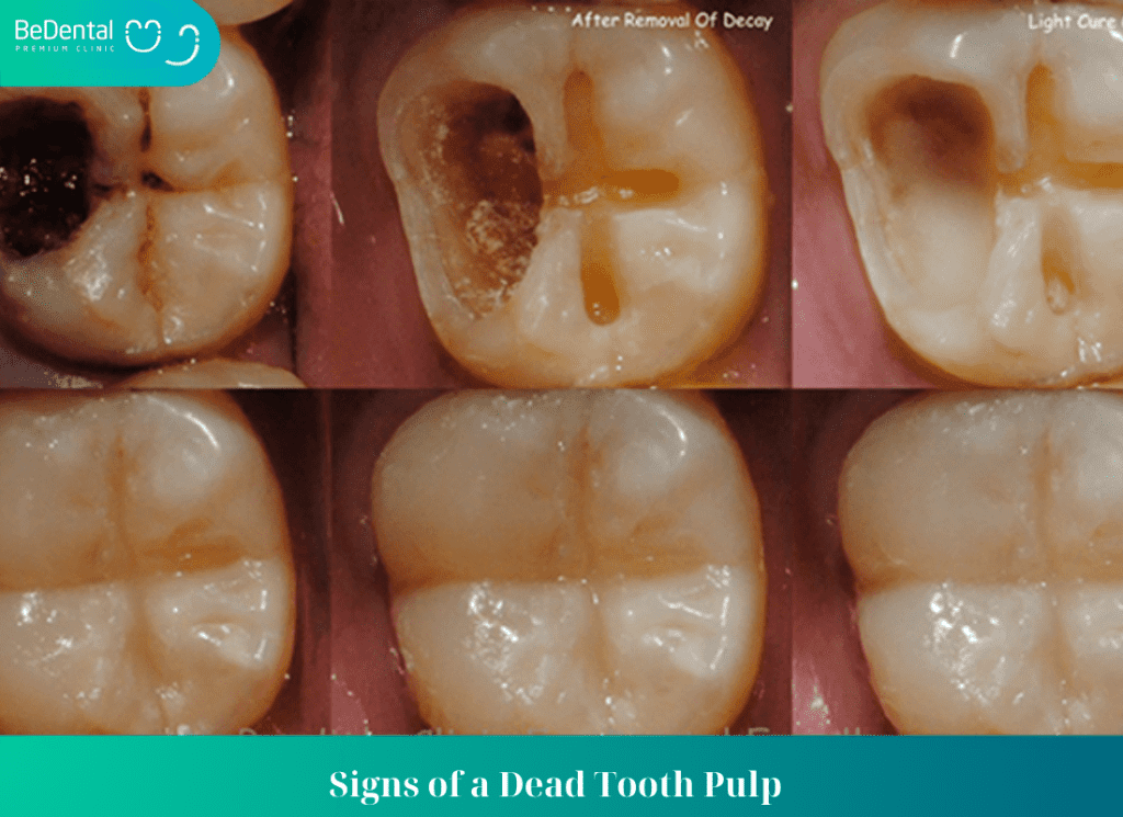 Signs of a Dead Tooth Pulp