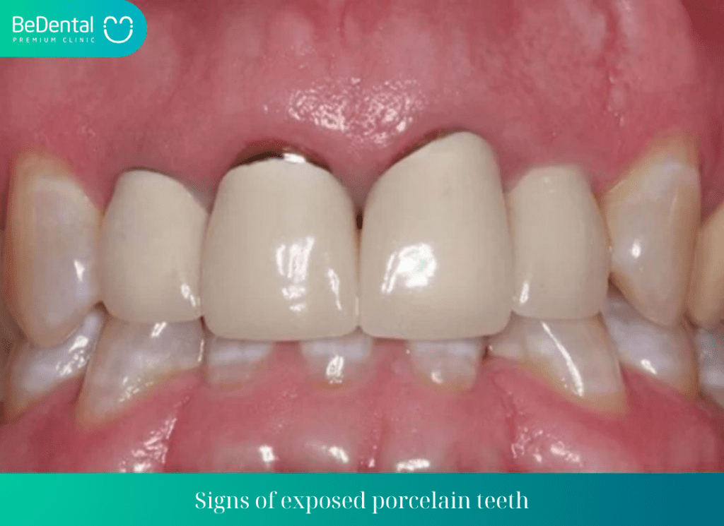 Signs of exposed porcelain teeth