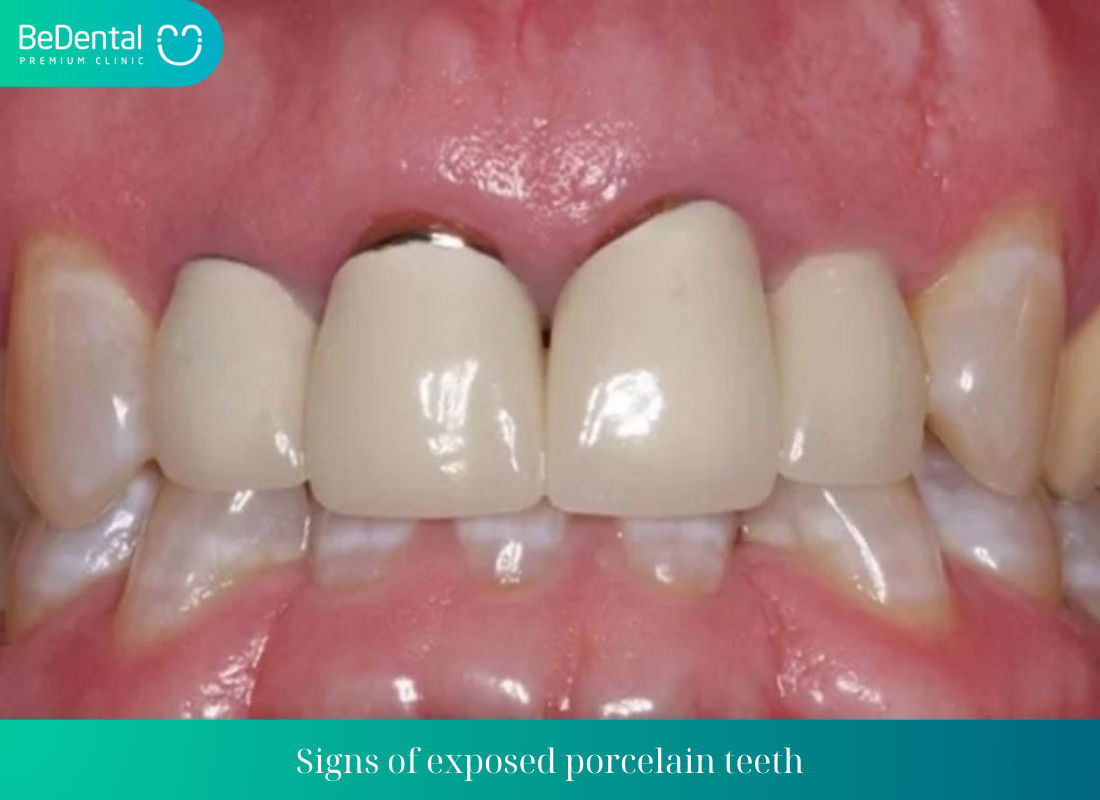 Signs of exposed porcelain teeth