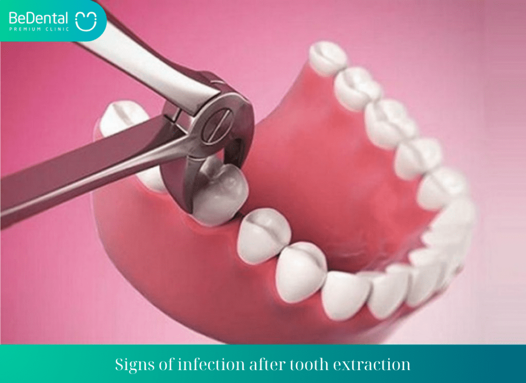 Signs of infection after tooth extraction