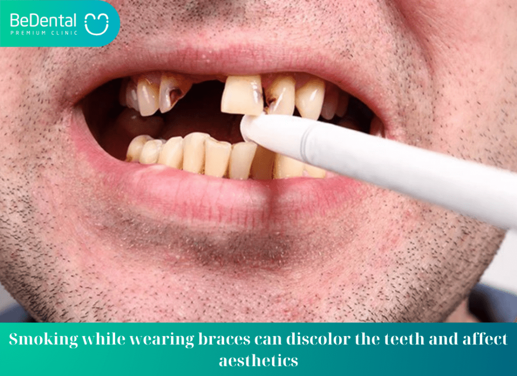 harmful effects of smoking while wearing braces