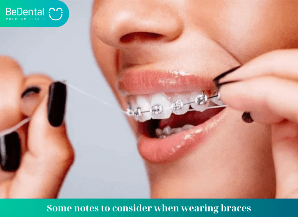 Some notes to consider when wearing braces