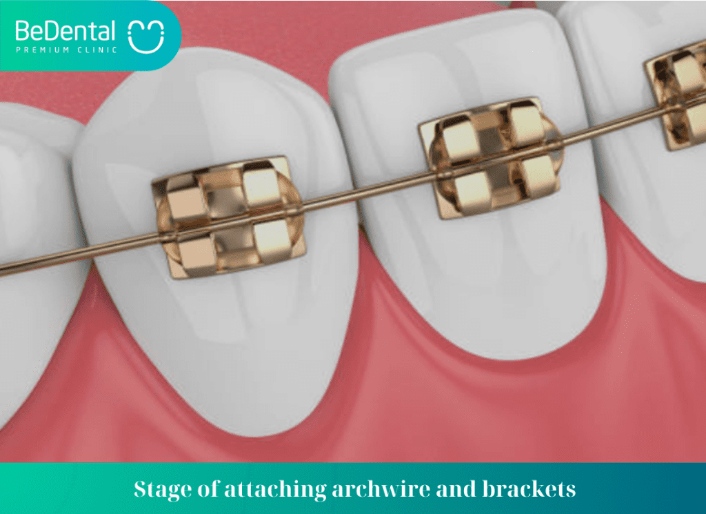 Stage of attaching archwire and brackets