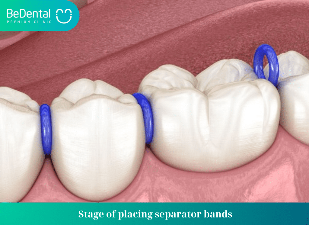 Stage of placing separator bands