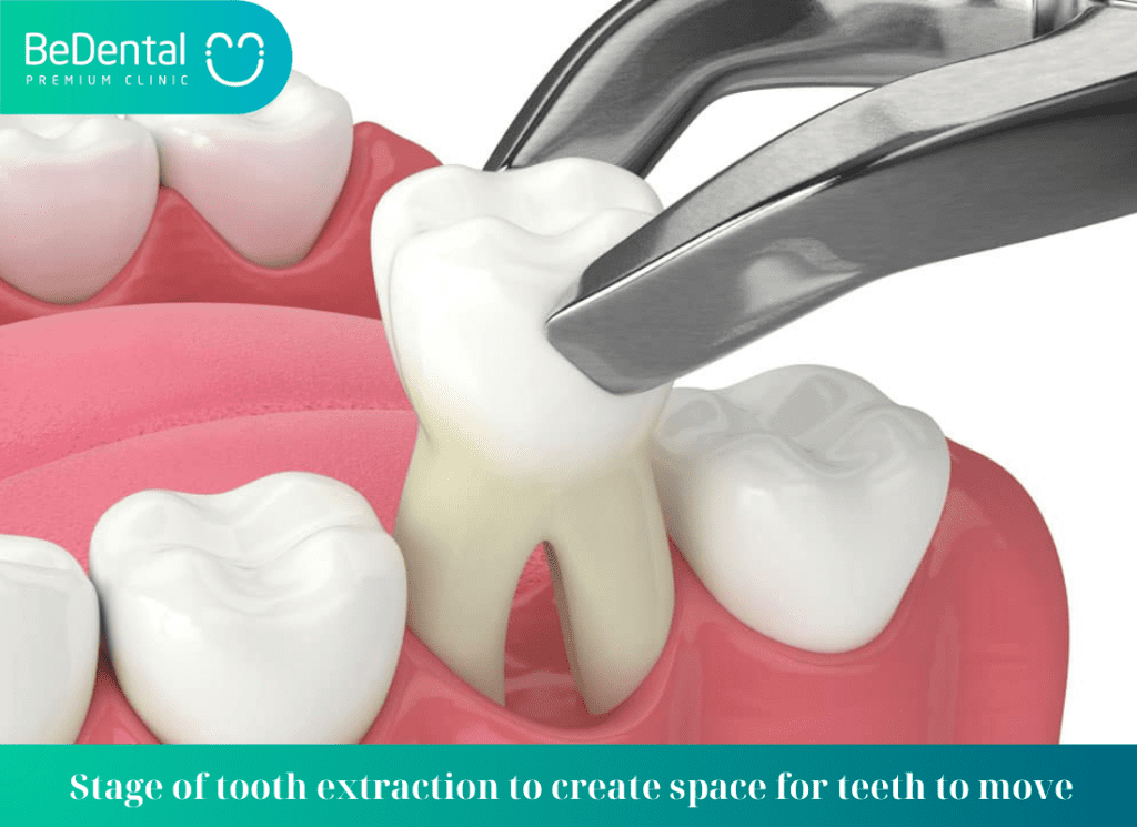 Stage of tooth extraction to create space for teeth to move