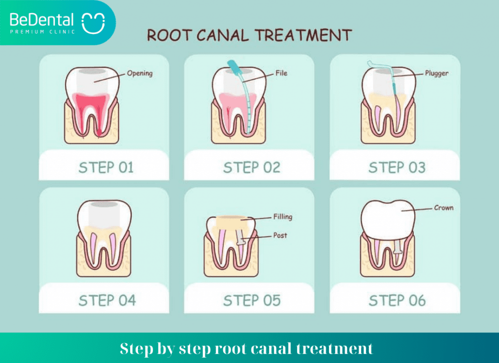 process of root canal treatment