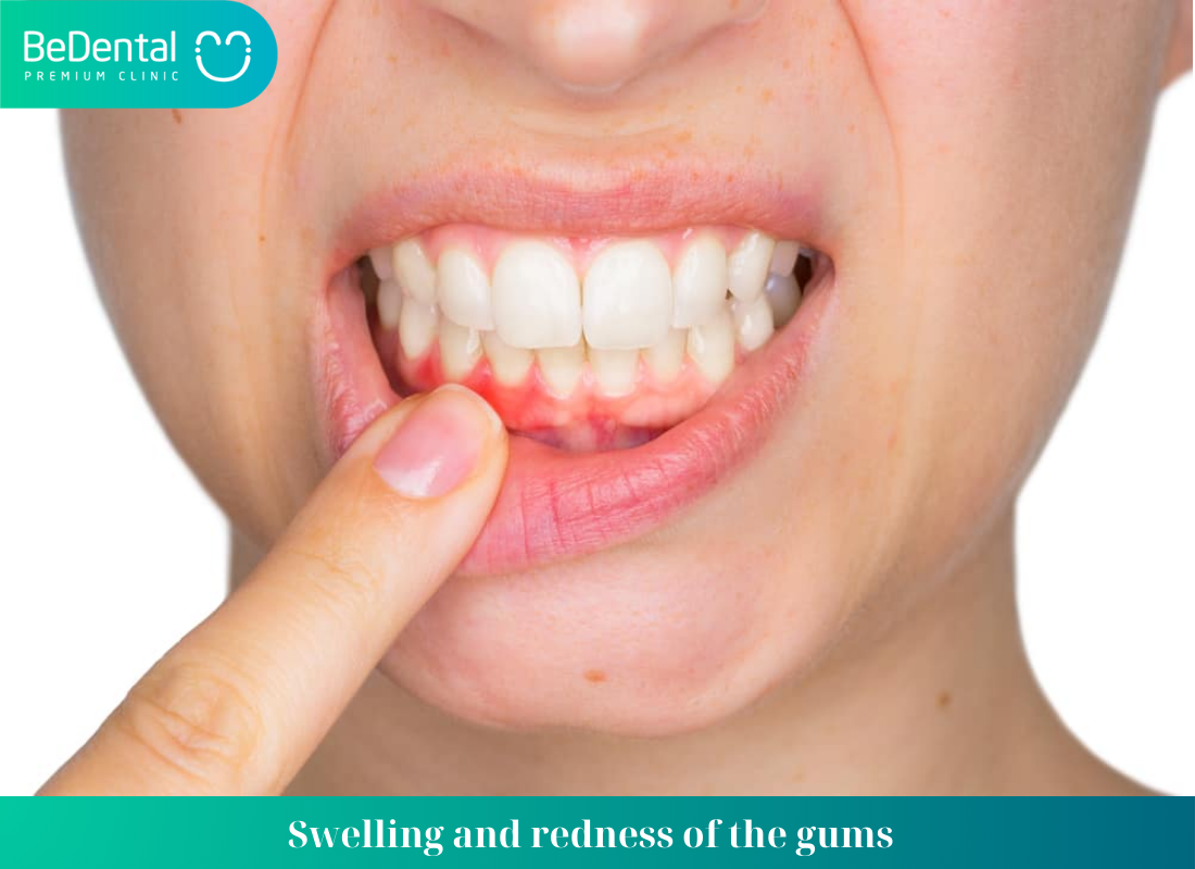 Swelling and redness of the gums