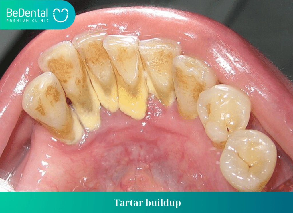 Tartar buildup