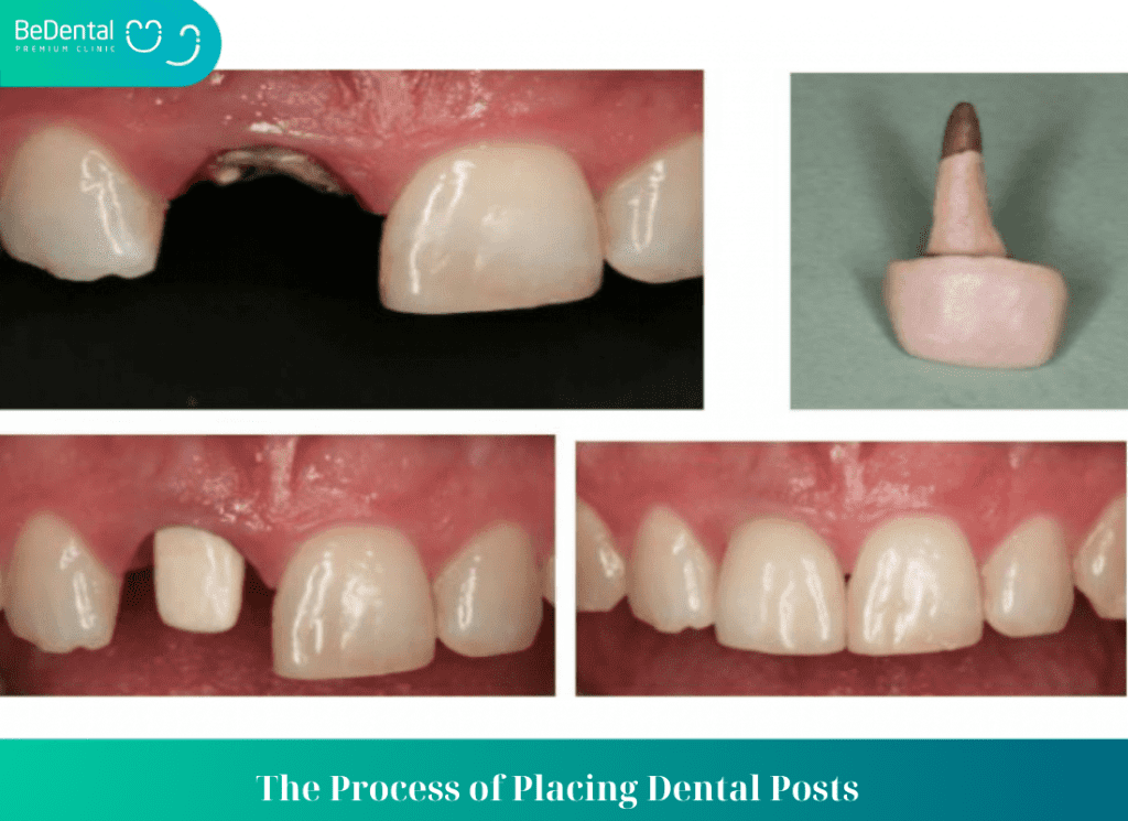 The Process of Placing Dental Posts