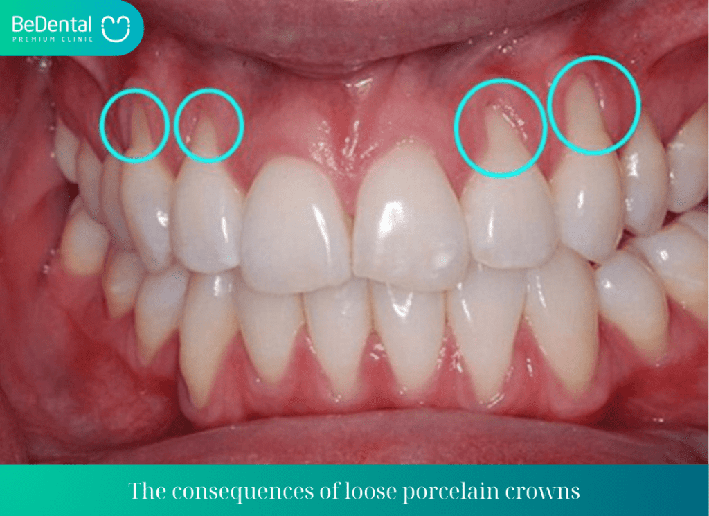 The consequences of loose porcelain crowns