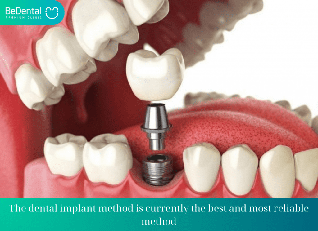 The dental implant method is currently the best and most reliable method