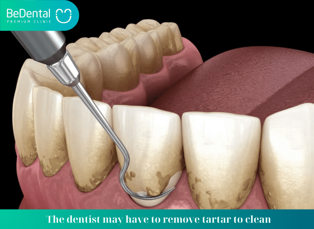 The dentist may have to remove tartar to clean