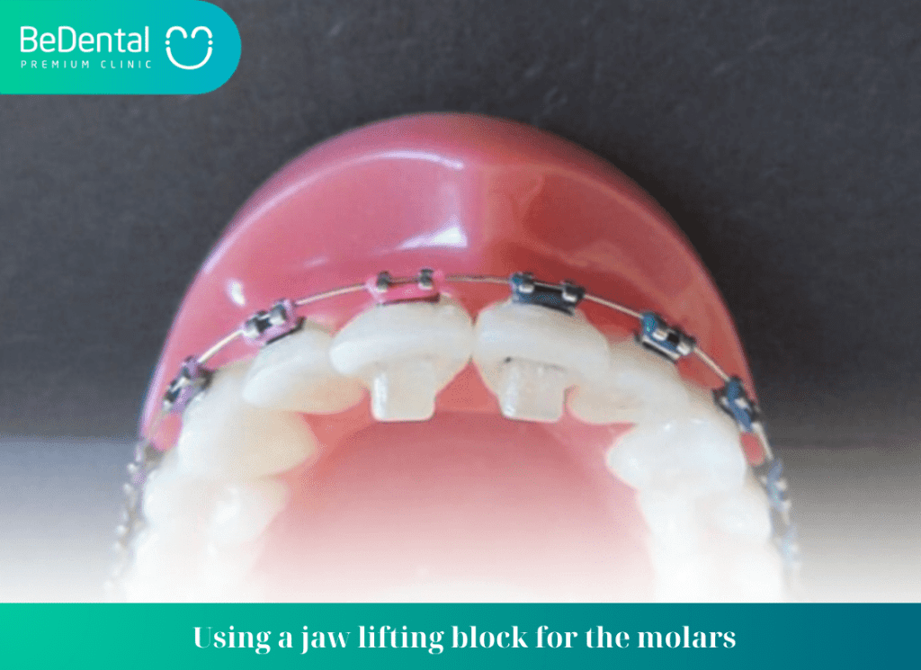 Using a jaw lifting block for the molars