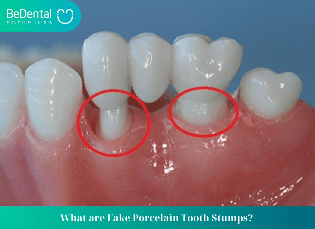 What are Fake Porcelain Tooth Stumps