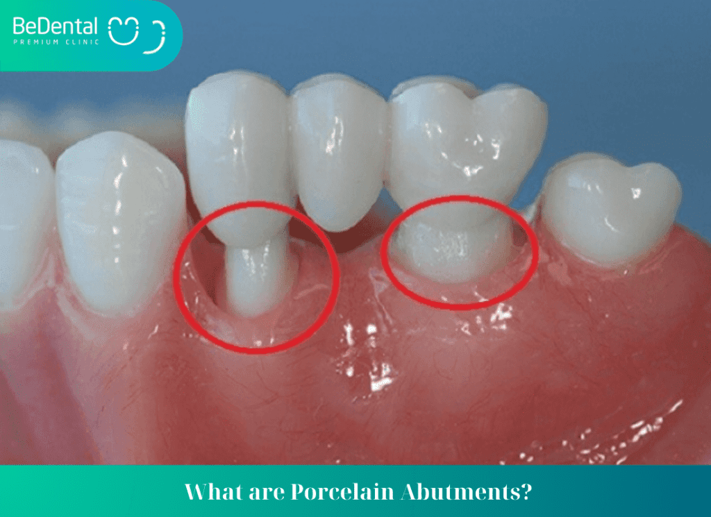 What are Porcelain Abutments?