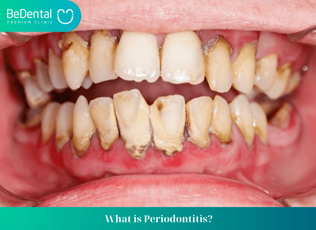 What is Periodontitis