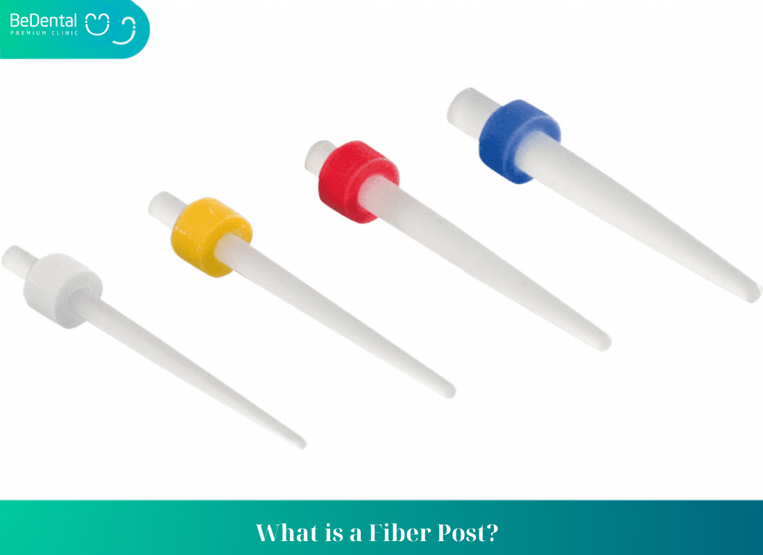 What is a Fiber Post