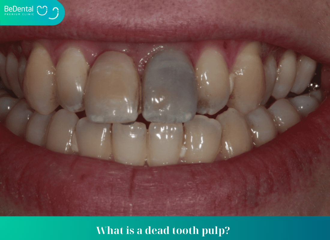 What is a dead tooth pulp