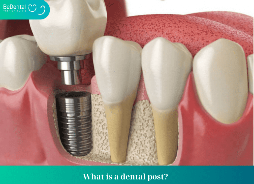 What is a Dental Post