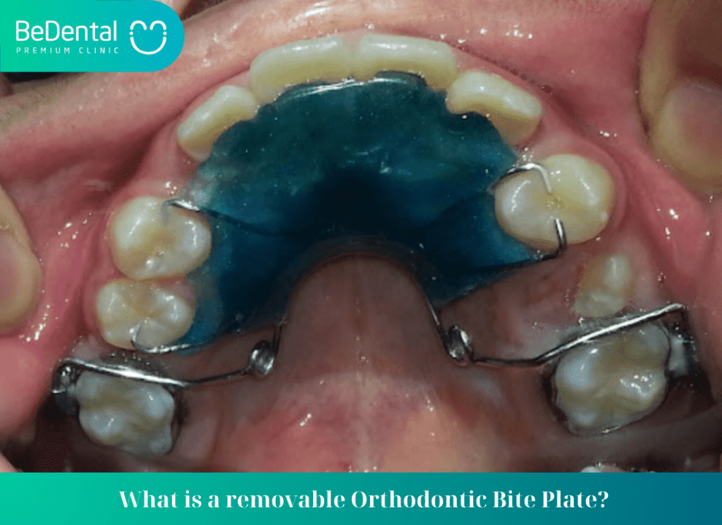 What is removable Orthodontic Bite Plate?