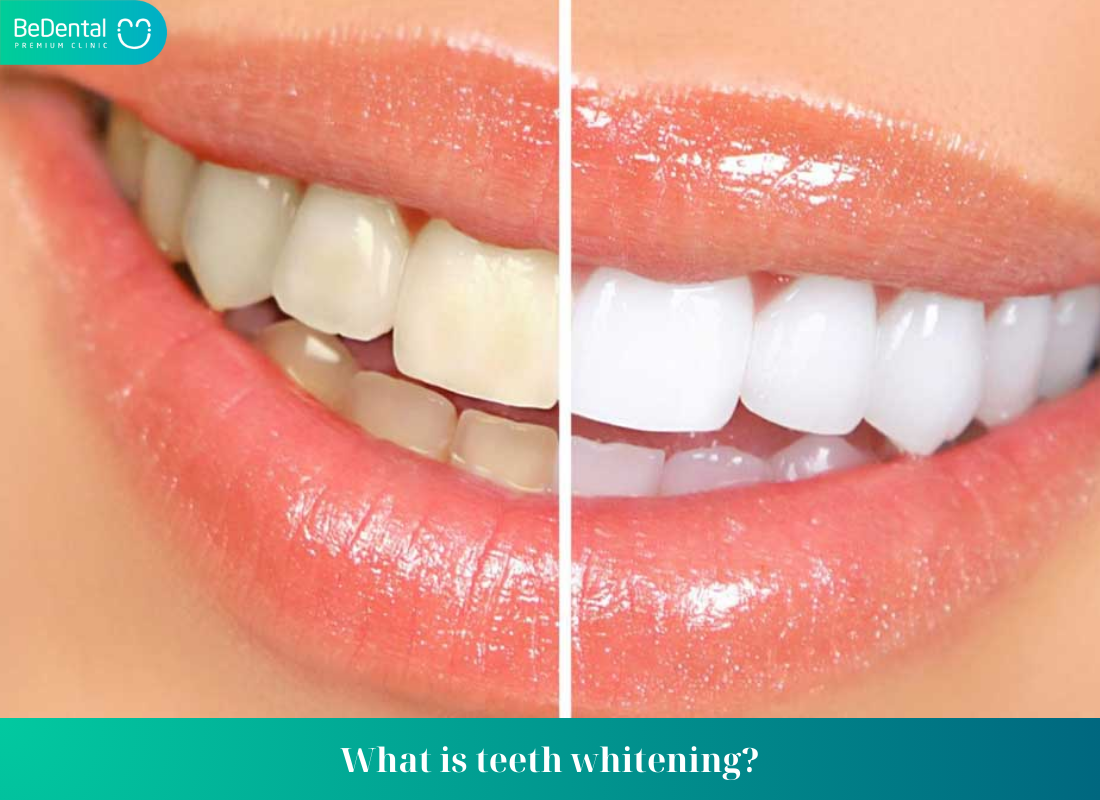 What is teeth whitening