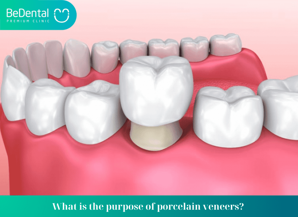 Are porcelain veneers necessary