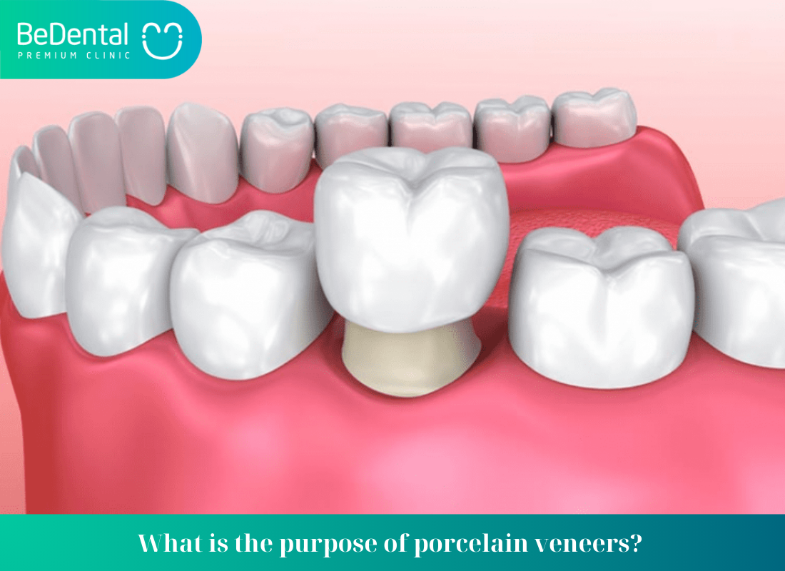 What is the purpose of porcelain veneers