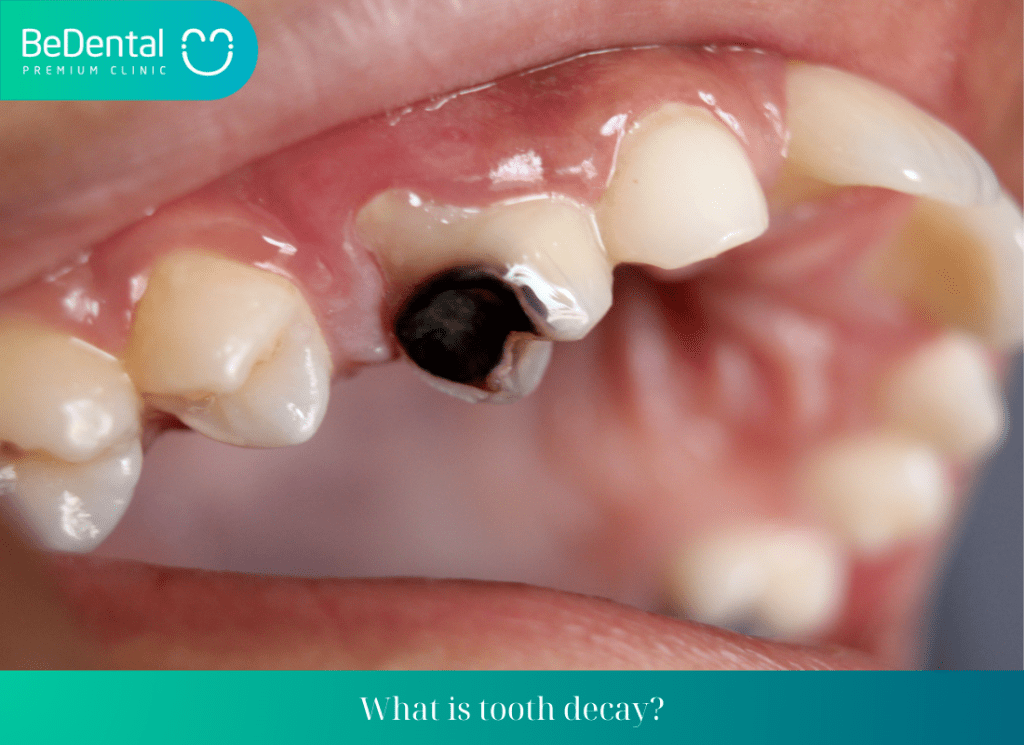 What is tooth decay