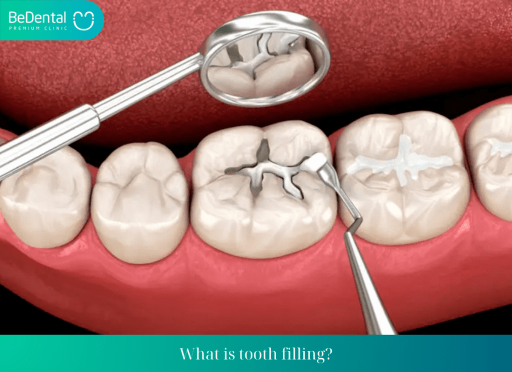 What is tooth filling