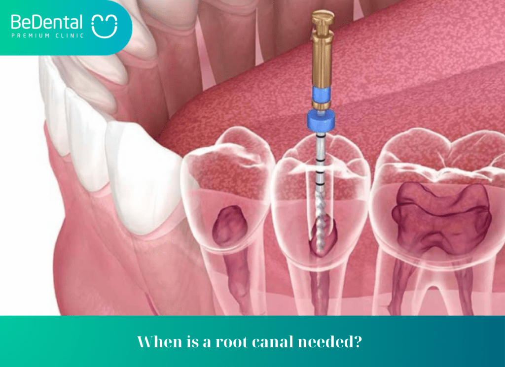 How much does a root canal cost?