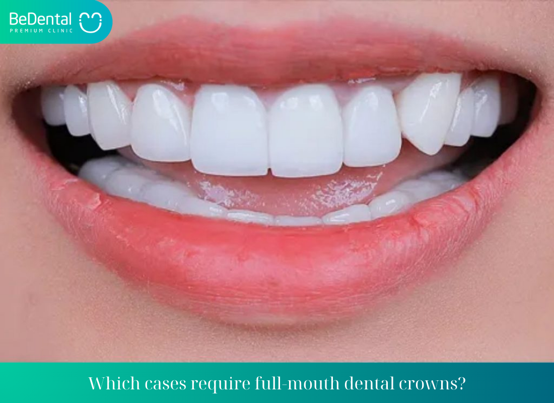 Which cases require full mouth dental crowns