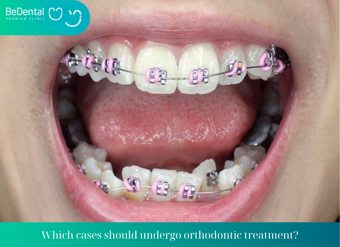 Which cases should undergo orthodontic treatment