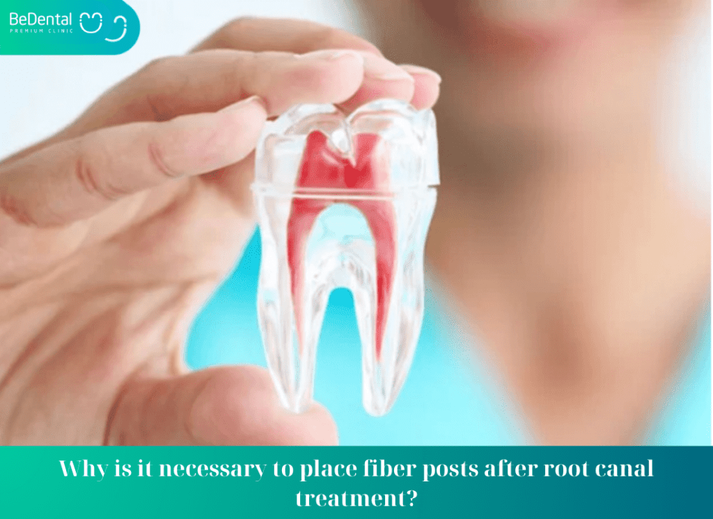 Why is it necessary to place fiber posts after root canal treatment