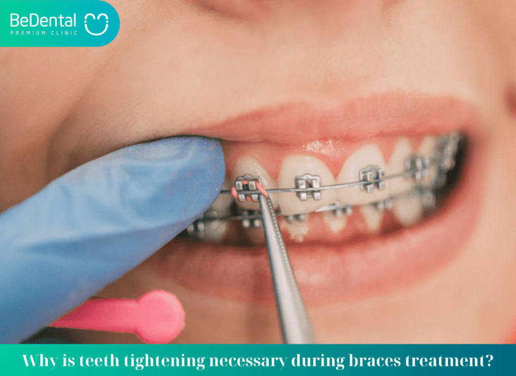 teeth tightening during braces