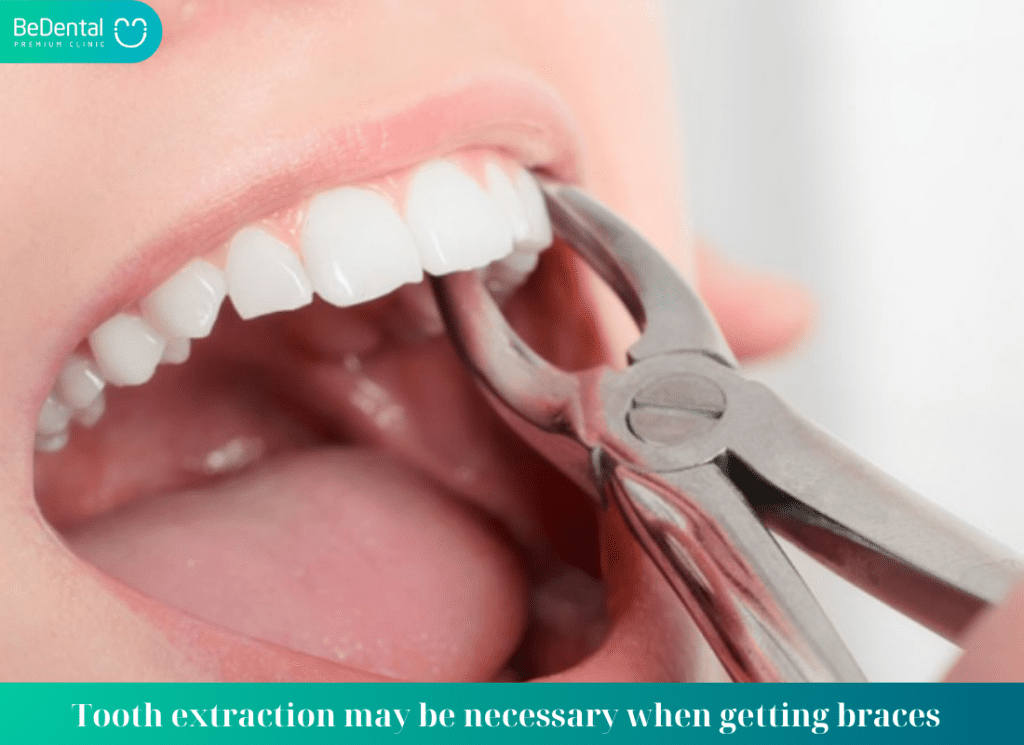 extract teeth before getting braces