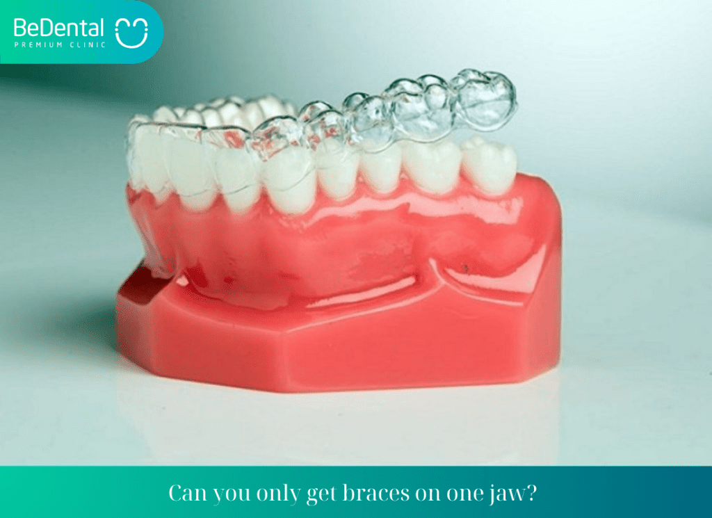 Can you only get braces on one jaw