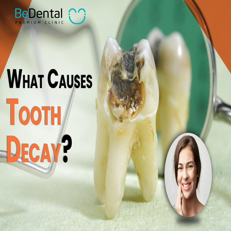 causes of tooth decay