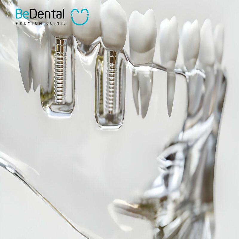 Comparing dental implants with other