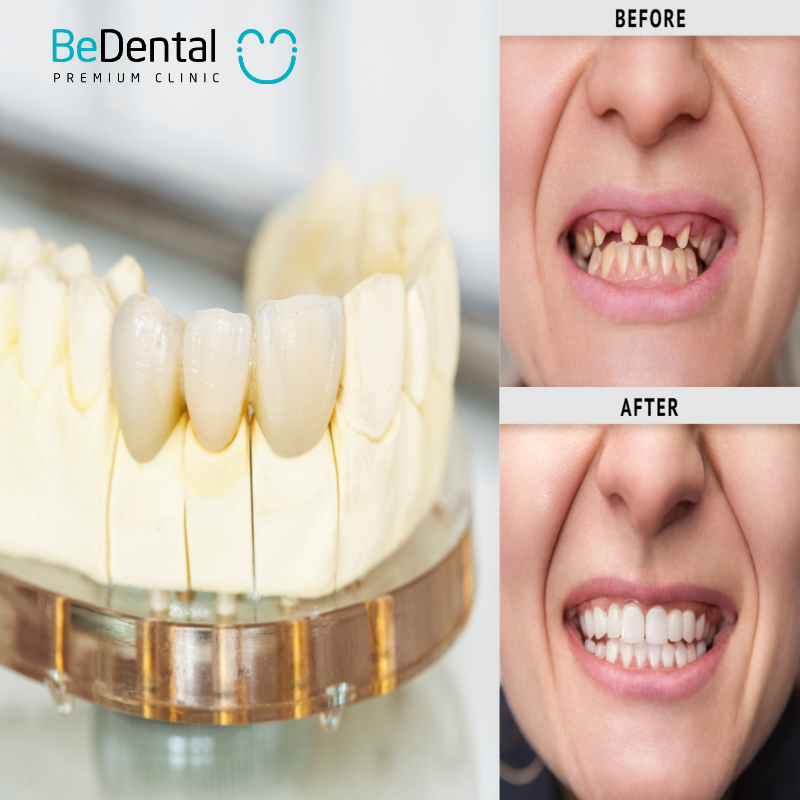 comparing different types of dental crowns