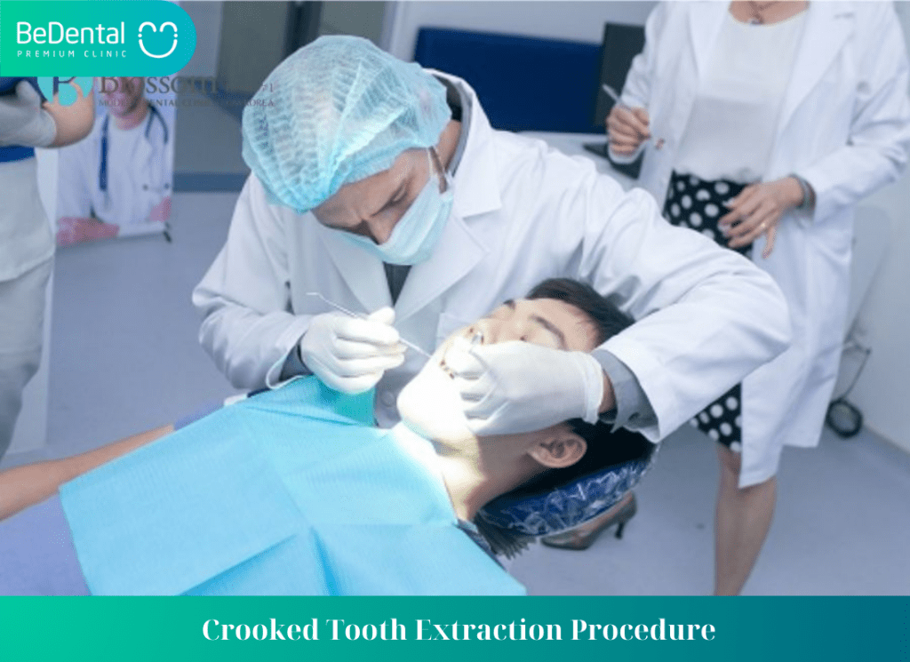 Crooked Tooth Extraction Procedure