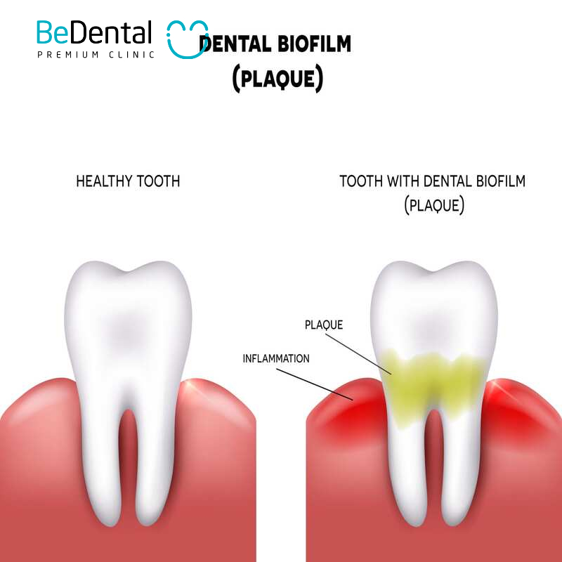 Dental Plaque Causes of Formation