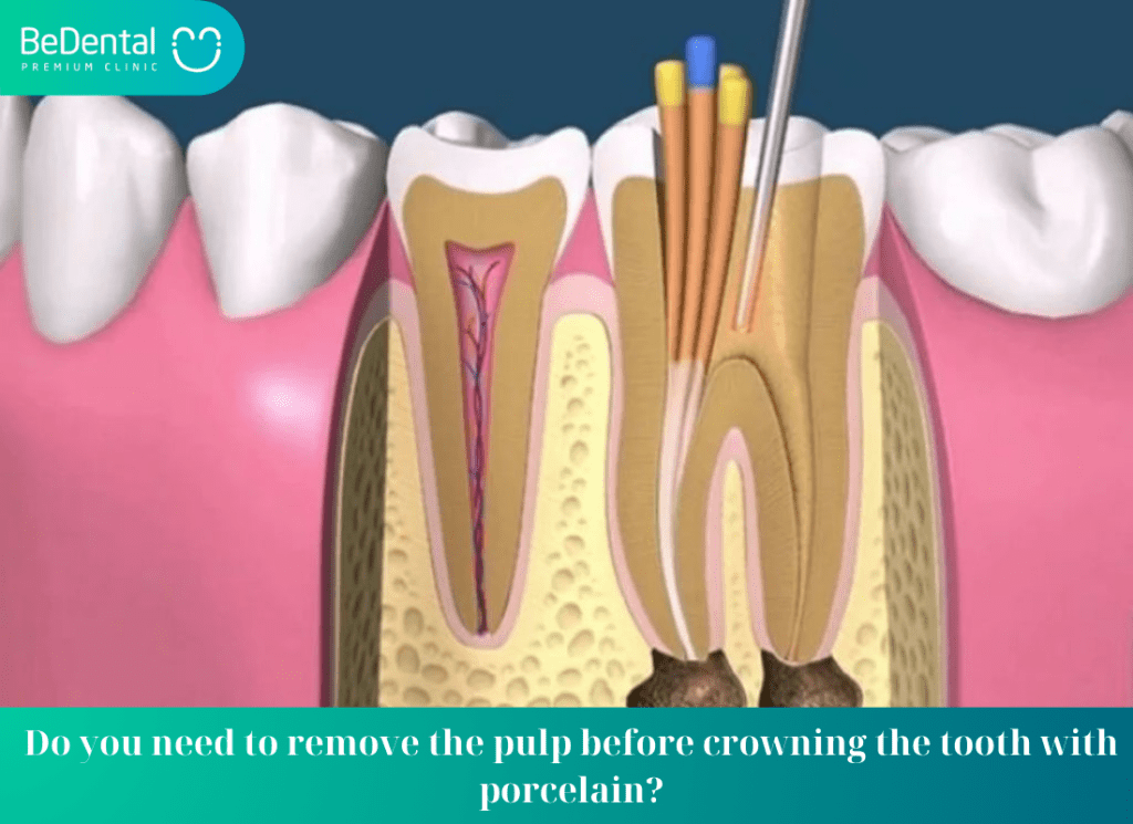 Do you need to remove the pulp before crowning the tooth with porcelain