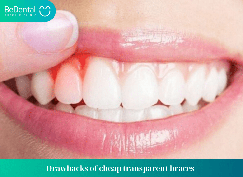 Drawbacks of cheap transparent braces