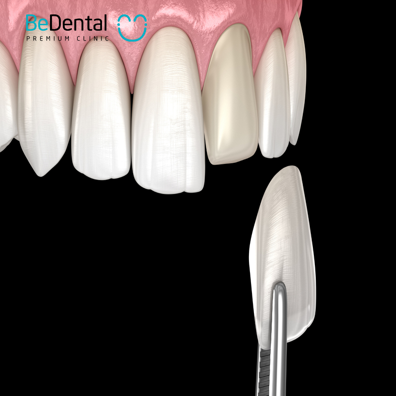 how durable are veneers