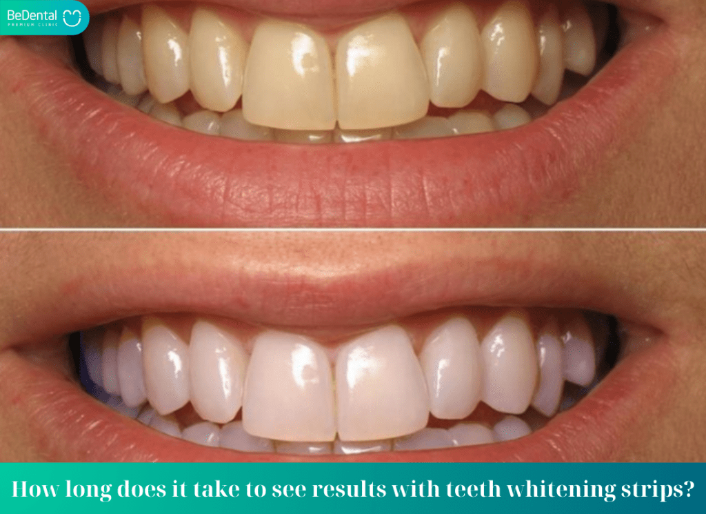 How long does it take to see results with teeth whitening strips