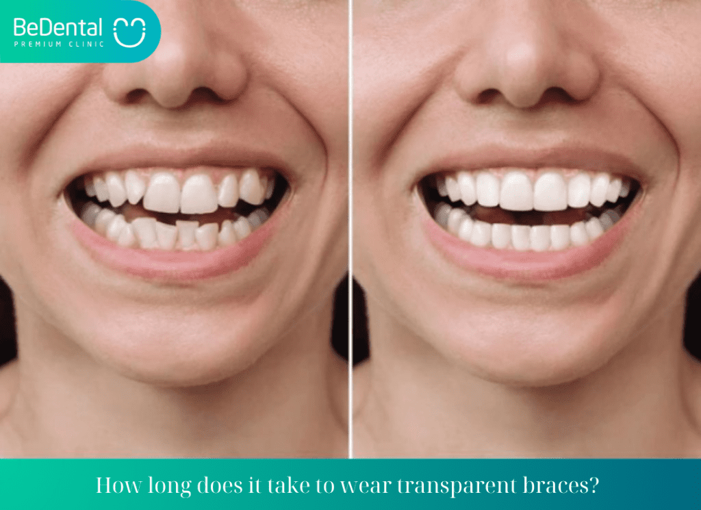 How long does it take to wear transparent braces