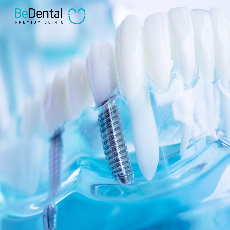 How to care for your teeth after dental implant