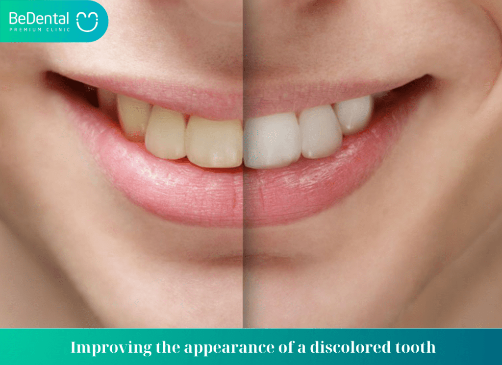 Improving the appearance of a discolored tooth