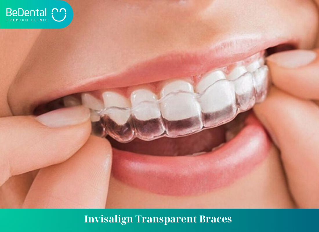 Invisalign Transparent Braces